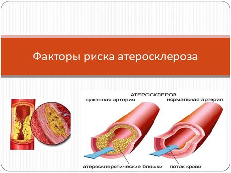 Факторы риска возникновения атеросклеротических бляшек