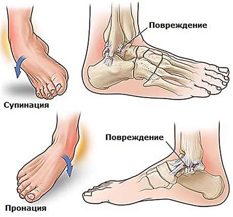 Физиотерапия для лечения растяжения связок на голеностопе