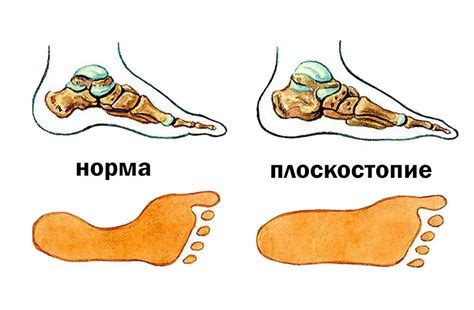 Физкультура и плоскостопие: важные аспекты