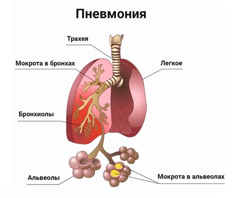 Чипсы при пневмонии: да или нет?