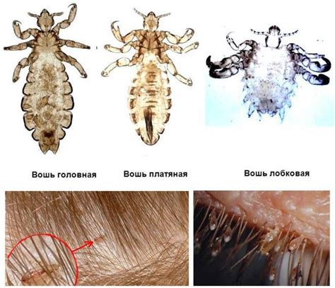 Что делать, если обнаружены вши или гниды: