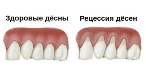 Что есть при разрезе десны?