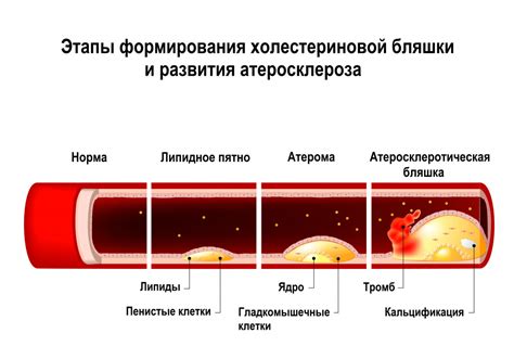 Что такое атеросклеротические бляшки и как их определить