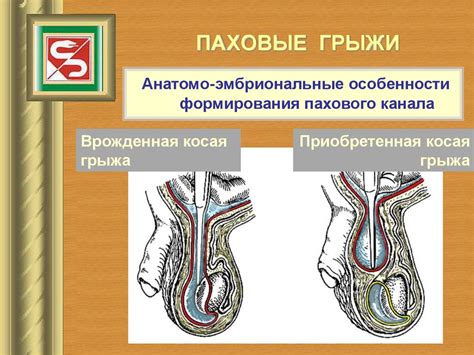 Что такое паховая грыжа?