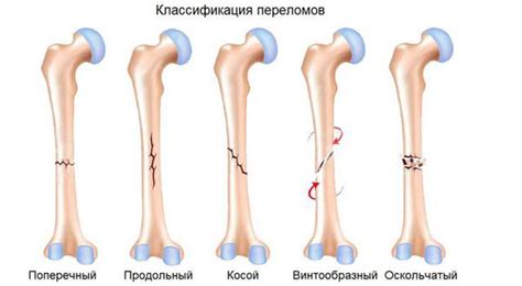 Что такое перелом ноги