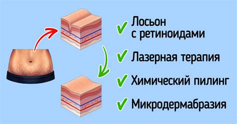 Что такое растяжки и как они образуются?