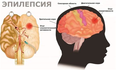 Что такое эпилепсия и как она проявляется у детей?