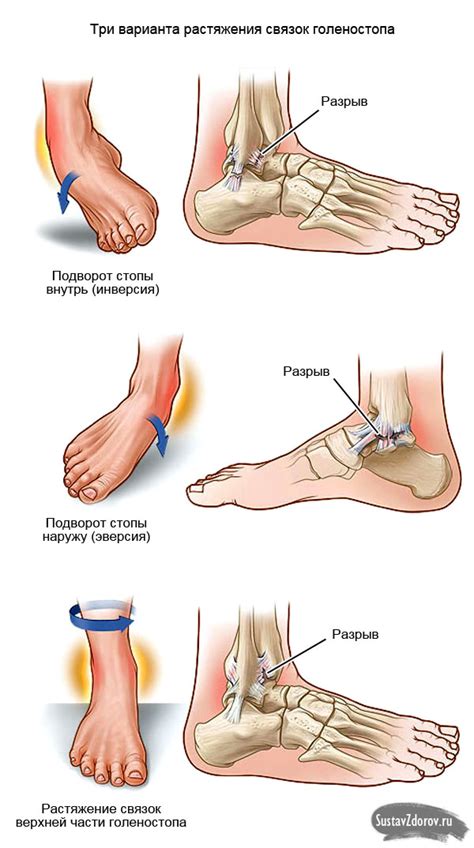 Этапы лечения растяжения связок на голеностопе