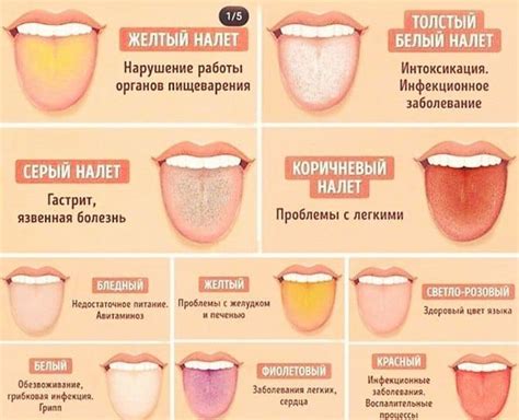 Эффективные средства профилактики налета на языке